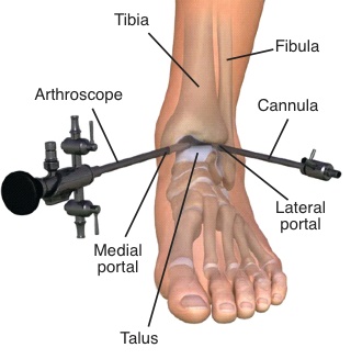 ankle arthroscopy surgery treatment